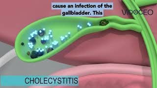 Acute cholecystitis explained [upl. by Osei206]