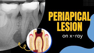 Periapical lesions Periapical Radiolucency Oral Pathology Bone Inflammatory Lesions [upl. by Uball688]