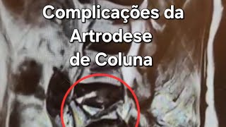 Complicações da Artrodese de Coluna  ferramenta que deve ser usada adequadamente [upl. by Htebesile]