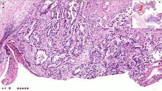 Adenocarcinoma of the Esophagus  Histopathology [upl. by Nylavad]