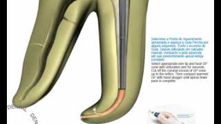 Sistema de obturación con gutapercha termoplastificada [upl. by Hcurob]