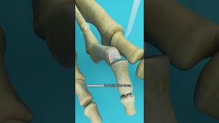 What is Hammer Toe and How to Fix It shorts viralvideo  Creativelearning3d [upl. by Kenway]