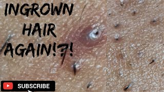 Hair inGrown Removal [upl. by Dacey180]