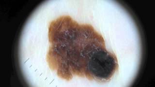 Moles and Melanoma [upl. by Fritzsche]