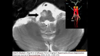 2 Hypertrophic olivary degeneration brain stem anatomy GABA GuillainMollaret MRI imaging [upl. by Weld]