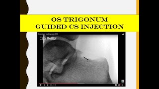 Injection  os trigonum CSI [upl. by Lewellen]