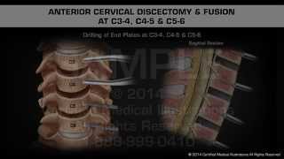 Anterior Cervical Discectomy amp Fusion at C34 C45 amp C56 [upl. by Silas125]