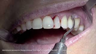 PROPHYLAXIS  Dr Gianluca Russo  Maintenance periodontal therapy [upl. by Eon132]