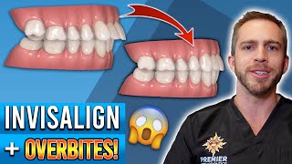 Invisalign Braces Before and After Overbite Crowding Teeth Cost Pain Tips 3M Clear Aligners [upl. by Guss]