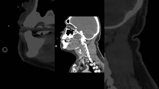 Epiglottitis CT [upl. by Clie]