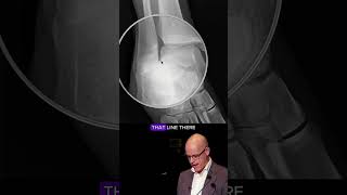 Ankle injury  Maisonneuve fracture [upl. by Gnil]