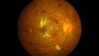 A Case Report on Subretinal Choroidal Neovascular Membrane [upl. by Frayne]