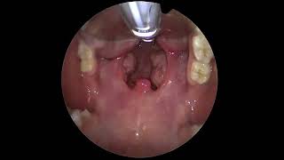 The Throat Exposure For Tonsillectomy Surgery [upl. by Anyak]