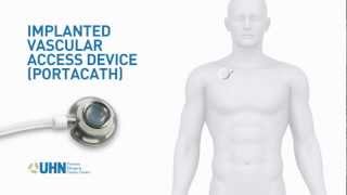 PortaCath Implanted Vascular Access Device [upl. by Nahgaem964]