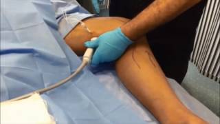 Supine popliteal block a new simple ultrasound guided technique [upl. by Attiuqaj]