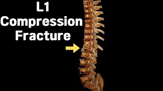 L1 Compression Fracture Spinal Challenge 제1요추 압박골절 척추의 도전 [upl. by Pepita]