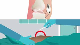 Reconstructive surgery is effective for recurrent kneecap dislocation [upl. by Esorrebma]