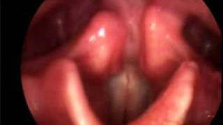 Singing Vocal Folds [upl. by Airec]