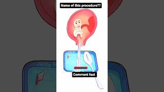 Comment the procedure procedure medical medicalprocedurevideos medicalprocedure medicalstudent [upl. by Perlis]