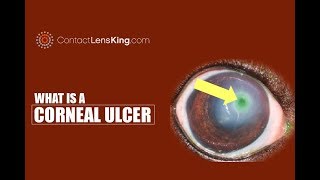 Corneal Ulcer Causes Symptoms Treatments [upl. by Nosrak]