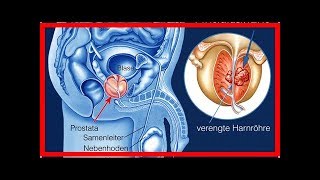 Forschern gelingt Durchbruch bei der Behandlung von Prostatakrebs [upl. by Clareta]