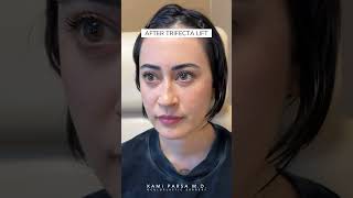 Eye Bags Goodbye Before and After Trifecta Lift with Dr Kami Parsa [upl. by Yellat400]