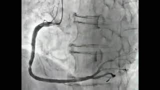 Coronary Angiography with Acetylcholine Injection  CoronaryArtery Vasospasm [upl. by Hassi]