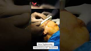 Skin Tightening with Embrace Rf Facetite for Facial Rejuvenation amp Youthful Skin [upl. by Riane]