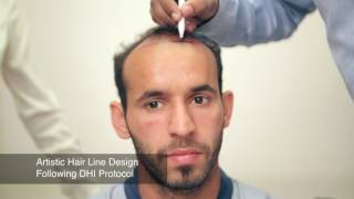 Hair Transplant in Delhi Hair Transplant Session of Ramandeep Singh Indian Hockey Player at DHI [upl. by Ateekal]