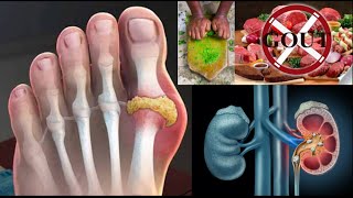 Uric acid gout and health [upl. by Shulamith699]