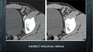 Abdominal hernia radiological features [upl. by Nnylyma]