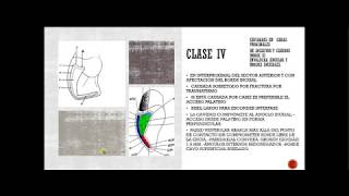 Clasificación de las cavidades dentales según Dr Black y la NUEVA ADICION CLASE VI [upl. by Nylsoj973]