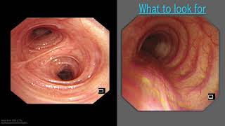 Mastering Bronchoscopy for Thoracic Surgery Chapter 5 [upl. by Stent]