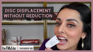 Disc Displacement Without Reduction  Priya Mistry DDS the TMJ doc articulardisc jawlocked tmd [upl. by Haslett853]