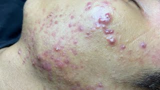 ACNE TREATMENT VU QUYNH MI  Blackheads Of Tweens 2024 EX [upl. by Frendel]