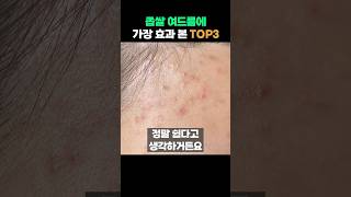 딱 3가지면 됩니다😎 좁쌀 여드름 무조건 효과 본 방법 TOP3👍 [upl. by Herwin]