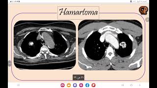 3 Lung Lesions  tuberculoma vs Hamartoma [upl. by Erialb]