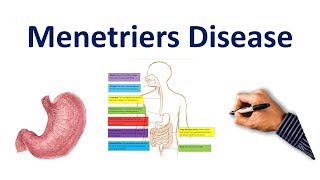 Menetriers Disease Made Easy USMLE Step 1 NCLEX COMLEX [upl. by Aiclid536]