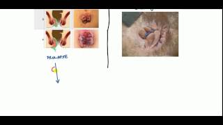 Hemorrhoids Lecture for USMLE [upl. by Eecal395]