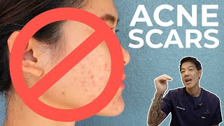 How to get rid of Acne Scars  Dr Davin Lim [upl. by Ynohtnaeoj163]