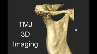 TMJ Imaging By CBCT acteon cbct tmj [upl. by Niuqram]