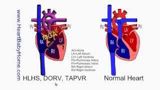 58  HLHS DORV TAPVR with Glenn and Fontan [upl. by Ribak]