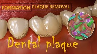 Dental Plaque [upl. by Korb]