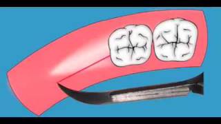 Distal Molar Surgery part 3mov [upl. by Frechette]