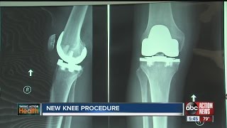 New knee procedure keeps healthy ligaments [upl. by Nonie641]