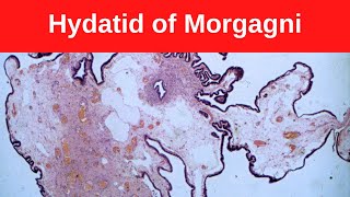 Hydatid of Morgagni  Pathology mini tutorial [upl. by Merrel]