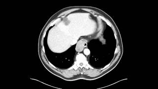 Esophageal leiomyoma of distal esophagus Chest CT [upl. by Francklin]