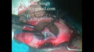 Conjunctival Graft Harvesting For Pterygium Excision With Autograft By Dr Sudhir Singh 32 [upl. by Shih]