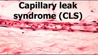 Capillary leak Syndrome [upl. by Stephanie]