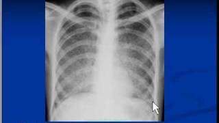 Chest xray interpretation  Miliary Tuberculosis [upl. by Elburr]